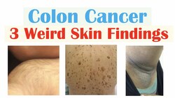 3 Weird Signs of Colon Cancer (Found on the Skin) Instructional Video