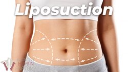 This Is What Happens During a Liposuction Instructional Video