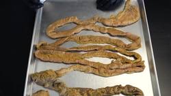 Understanding Bowel Obstructions: My Personal Experience Instructional Video