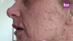 Neurofibromatosis Leaves Mum's Body Covered In Lumps: BORN DIFFERENT Instructional Video