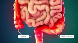 Ulcerative Colitis Instructional Video