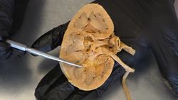 Understanding Kidney Stones: Causes, Formation, and Prevention Instructional Video