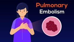 Overview of Acute Pulmonary Embolism in adults: (From DVT to PE) Instructional Video
