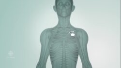 The problem with tracking and testing medical devices | The Implant Files News Clip