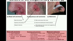 Anatomy | The Three Types of Skin Cancers Instructional Video