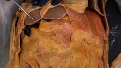 The Importance of Vitamin D for Your Body: Synthesis and Functions Explained Instructional Video