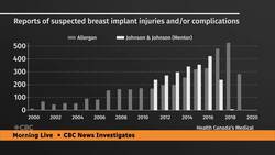 Thousands of suspected injuries tied to breast implants, CBC analysis finds News Clip