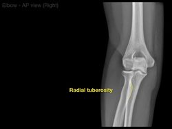 Anatomy of Elbow X-rays Instructional Video