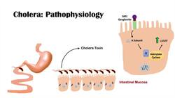 Cholera (Vibrio Cholerae) Pathophysiology, Risk Factors, Symptoms, Diagnosis, and Treatment Instructional Video