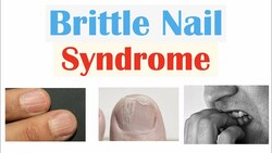 Brittle Nail Syndrome | Causes, Signs & Symptoms, Diagnosis, Treatment, Supplements Instructional Video