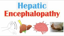 Hepatic Encephalopathy | Pathophysiology, Triggers, Signs & Symptoms, Diagnosis, Treatment Instructional Video