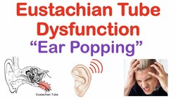 Eustachian Tube Dysfunction (“Popping Sound in Ears”) | Causes, Symptoms, Diagnosis, Treatment Instructional Video