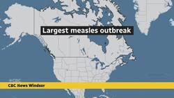 Health units need more funding to fight measles, NDP critic says News Clip