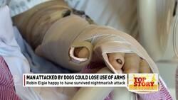 Man attacked by dogs could lose use of arms News Clip