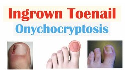 Ingrown Toenail (Onychocryptosis) | Causes, Risk Factors, Signs & Symptoms, Diagnosis, Treatment Instructional Video