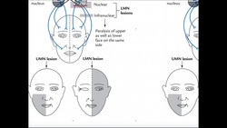 Mechanism of Facial (Bell's) Palsy and Clinical Interpretation Instructional Video