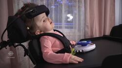 Toddler survives 'drastic' skull reconstruction surgery News Clip