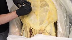 Understanding Hernias: Anatomy and Differences between Men and Women Instructional Video