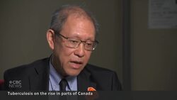 Fight against tuberculosis hurt by resources diverted to COVID-19 News Clip