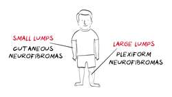 What is Neurofibromatosis Type 1 (NF1)? Instructional Video