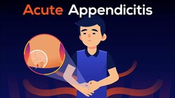 What is Appendicitis? A real case of Burst Appendix. Instructional Video