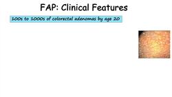 “Colon Cancer That Runs in Families” (Familial Adenomatous Polyposis), APC Gene, Symptoms, Treatment Instructional Video