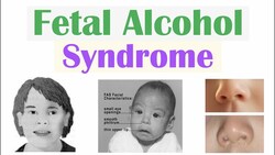 Fetal Alcohol Syndrome (FAS) | Risk Factors, Pathophysiology, Signs & Symptoms, Diagnosis, Treatment Instructional Video