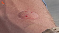 VENOM EXTRACTION - Centipede Bite Aftermath! Instructional Video