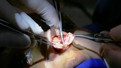 Removal of nasal septum during actual surgical procedure of nasal septum deviation correction and rhinoplasty. Female patient under general anesthesia. Stock Footage