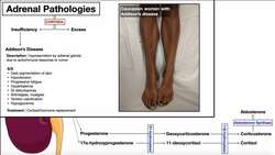 Adrenal Pathologies | Addison's & Cushing's Diseases Instructional Video