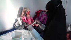 CLEAN : Disfigured by acid, the face of violence against Yemen's women News Clip