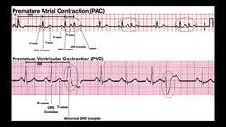 EKG Patterns Premature Atrial & Ventricular Contractions [PACs & PVCs] Instructional Video