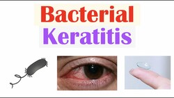 Bacterial Keratitis (Eye Infection From Contact Lenses) | Causes, Symptoms, Diagnosis, Treatment Instructional Video