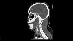 CT angiography of Head and neck . Stock Footage