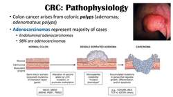 Colon Cancer (CRC) Risk Factors, Pathogenesis, Symptoms, Diagnosis, Staging, Treatment Instructional Video