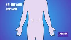 There's A New Experimental Treatment For Alcohol, Drug Addiction News Clip