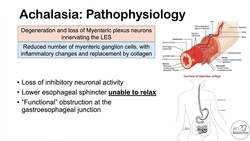 Achalasia | Pathophysiology, Causes, Signs & Symptoms, Diagnosis, Treatment Instructional Video