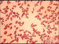 Genetics in Action: Genetic Disorders Instructional Video