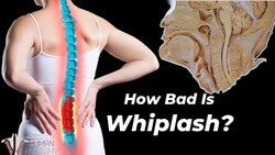 How Whiplash Can Destroy Your Neck... Instructional Video