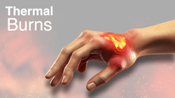 Thermal Burns - Cooling, Treating and Seeking Medical Care Instructional Video