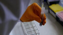 A test is carried out on blood in a laboratory to measure changes in cholesterol levels. Stock Footage
