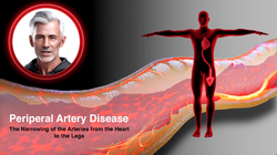 Peripheral Artery Disease - Prevention through Healthy Lifestyle Choices Instructional Video