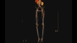 CT SCAN of lower extremity . Stock Footage