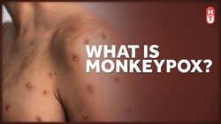 Monkeypox: What is It and Who is at Risk? Instructional Video