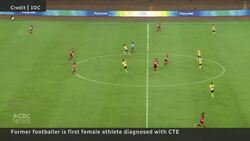 Concussion-related CTE brain disease found in 1st female athlete News Clip