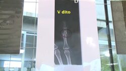 CLEAN : Broken bones on X-rays lay bare domestic violence in Italy News Clip