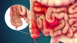Inflammatory Bowel Disease (IBD) Instructional Video