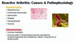 Reactive Arthritis & Reiter’s Syndrome | Causes, Signs & Symptoms, Diagnosis, Treatment Instructional Video