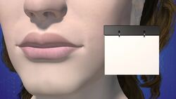 How are lip fillers removed? Instructional Video