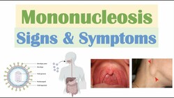 Infectious Mononucleosis (Mono) Signs & Symptoms Instructional Video